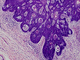 <span class="mw-page-title-main">Folliculosebaceous cystic hamartoma</span> Medical condition