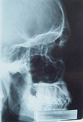 一位男性头骨X光影像