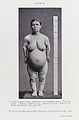 An achondroplasic female, c 1912 Wellcome L0033869.jpg