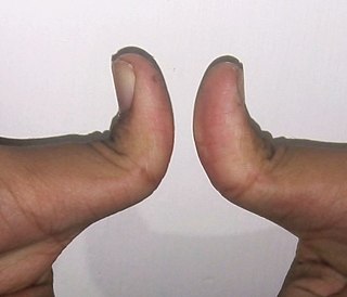 <span class="mw-page-title-main">Hitchhiker's thumb</span> Condition in which the thumbs can bend backwards 90°