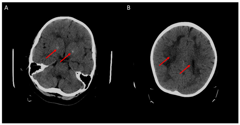 File:Cerebral Folate Deficiency - Cerebral CT-scan at 4 years old.png