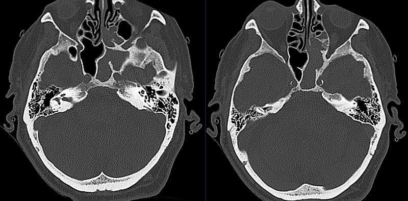 File:Chronische Sinusitis sphenoidalis 86M - CT axial - 001.jpg