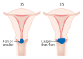 Stage 1B cervical cancer