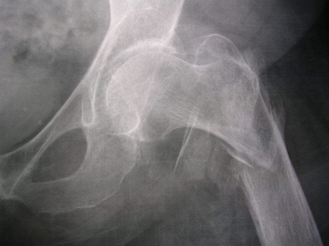 File:Plâtre fracture du poignet.jpg - Wikimedia Commons