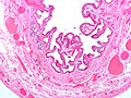 Micrografía de colesterolosis de la vesícula biliar