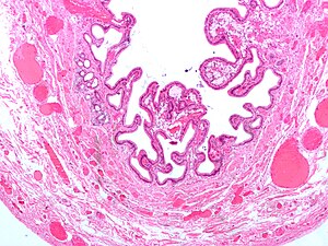 Gallbladder cholesterolosis micro.jpg