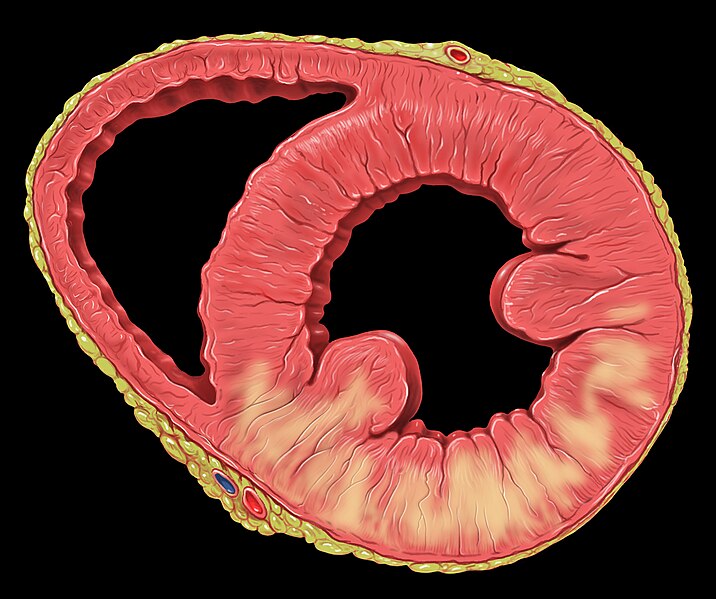 File:Heart inferior wall dysfunction.jpg