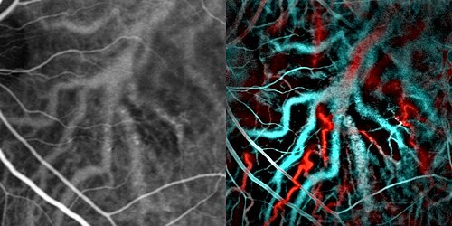 Indocyanine green angiography (left) and laser Doppler imaging (right) of the macula in central serous retinopathy, revealing choroidal vessels. Blue and red correspond to low and high blood flow respectively. ICG vs LDH in CSCR.jpg