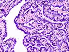 Papiloma intraductal com metaplasia apocrina - Hpv warts spread