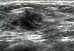 Thumbnail for Breast ultrasound