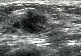 <span class="mw-page-title-main">Breast ultrasound</span>