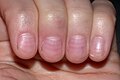 Ногти поврежденные в процессе химиотерапии