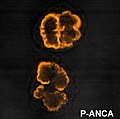 Miniatura para Anticuerpos anticitoplasma de neutrófilos