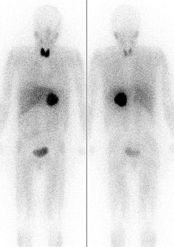 Pheochromocytoma seen like a dark sphere in center of the body. Image is by MIBG scintigraphy with radiation from radioiodine in the MIBG. However, note unwanted uptake of radioiodine from the pharmaceutical by the thyroid gland in the neck, in both images (front and back) of the same patient. Radioactivity is also seen in the bladder.