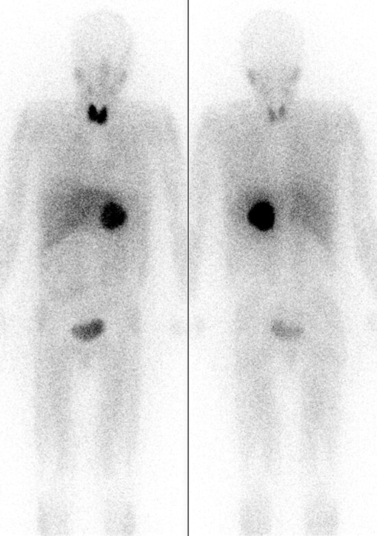 A pheochromocytoma tumor is seen as a dark sphere in the center of the body (it is in the left adrenal gland). The image is by MIBG scintigraphy, show