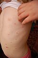 A 3-year-old girl with a chickenpox rash on her torso