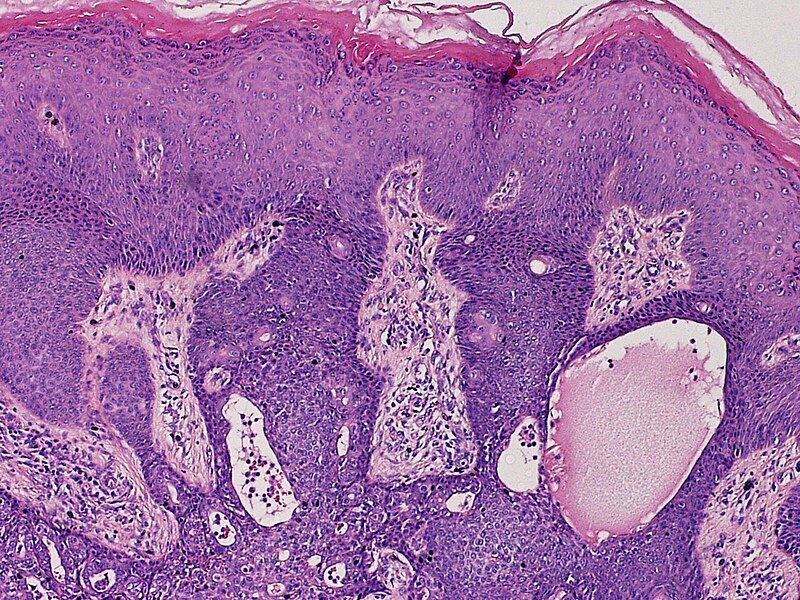 File:SkinTumors-P7110452.JPG