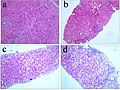 Miniatura para Esteatosis