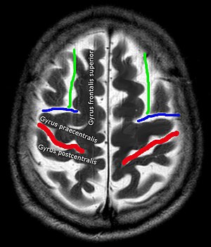 Sulcus centralis - Identification axial - MRI T2.jpg
