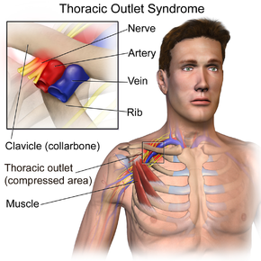 290px thoracic outlet syndrome