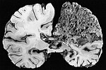 Miniatura para Malformación arteriovenosa