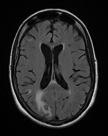 MRI: Cerebral toxoplasmosis with primary involvement in the right occipital lobe (at left and below of the image). 48-year-old woman with AIDS BrainToxoplasmosis MRI 2 09.png