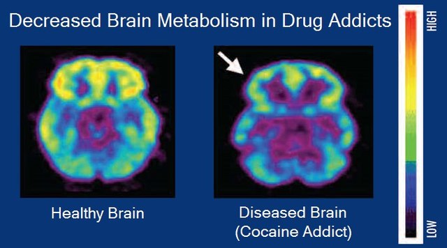 effects of drug addiction on the brain