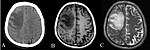 CT and MRI scan of the brain with melioidosis.jpg