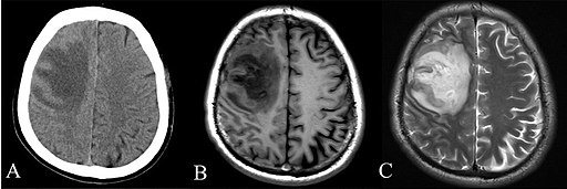 CT and MRI scan of the brain with melioidosis