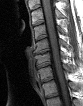 Cervical Spine MRI showing degenerative changes closeup.jpg
