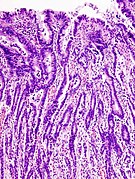 Gastric adenocarcinoma (1) well differentiated.jpg
