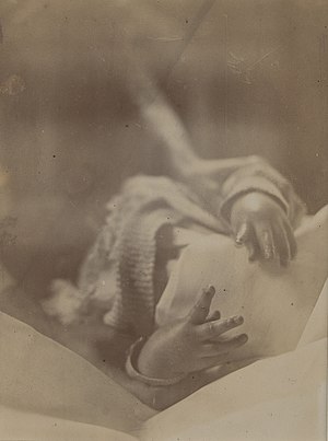 Hands of a baby affected with tetany Wellcome L0067011.jpg