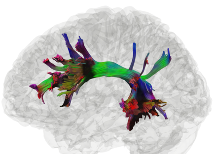 High-definition fiber tracking of arcuate fasciculus High-definition fiber tracking.tif