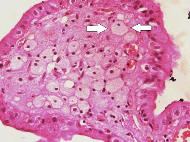 Foam cell - Wikipedia