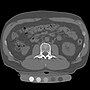 Thumbnail for Quantitative computed tomography
