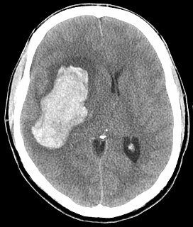 Hypertensive emergency