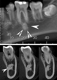 Idiopathic osteosclerosis Medical condition