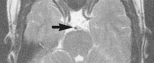 Fig. 2. Flow-related signal loss in the carotid and basillary arteries (T2 axial study of the brain). MRI with flow-related signal loss.jpg