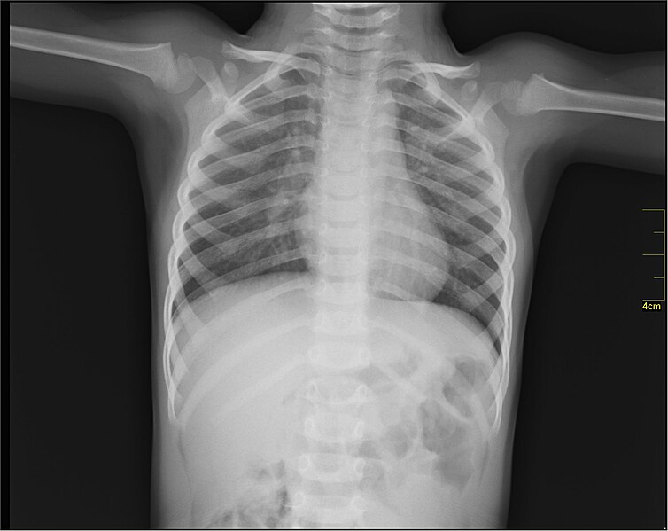 File:Medical X-Ray imaging AAS02 nevit.jpg