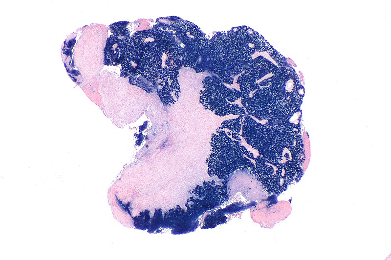 nasopharyngeal carcinoma symptoms