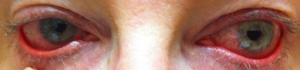 Ocular rosacea.png