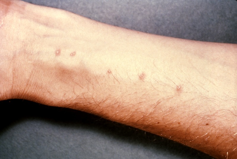 File:Schistosomiasis itch.tif