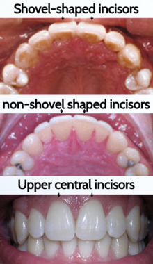Shovel-shaped incisors and non-shovel-shaped incisors Shovel shaped incisors.png