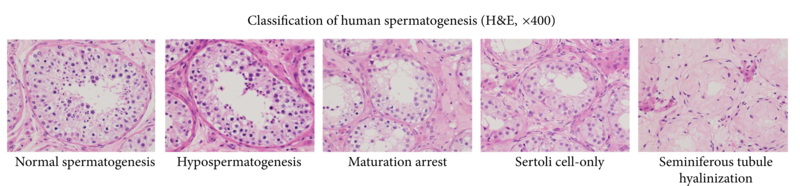 File:Spermatogenesis pathologies.png