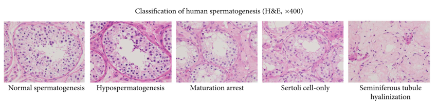 Spermatogenesis pathologies.png