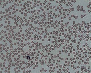 Thrombocytopenia A blood platelet disease characterized by a low platelet count in the blood.