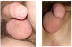 Thumbnail for File:Unbeschnitten (mit Phimosis) und beschnittener Penis compare uncircumcised circumcised penis.png