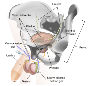 <span class="mw-page-title-main">Vas-occlusive contraception</span> Form of male contraception that blocks sperm transport in the vas deferens