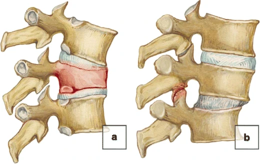 File:Vertical and horizontal instability of the spine.webp