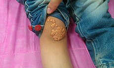 Xanthoma.jpg